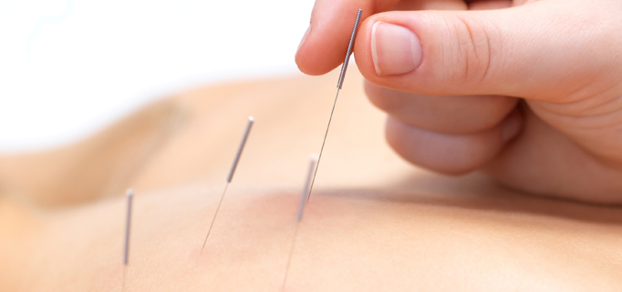 What are the Benefits of Dry needling in Physiotherapy