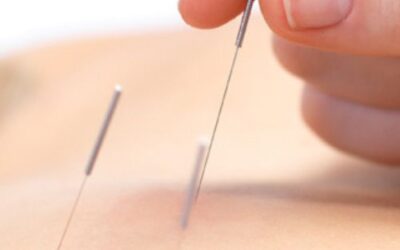 What are the Benefits of Dry needling in Physiotherapy?