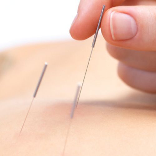 What are the Benefits of Dry needling in Physiotherapy?